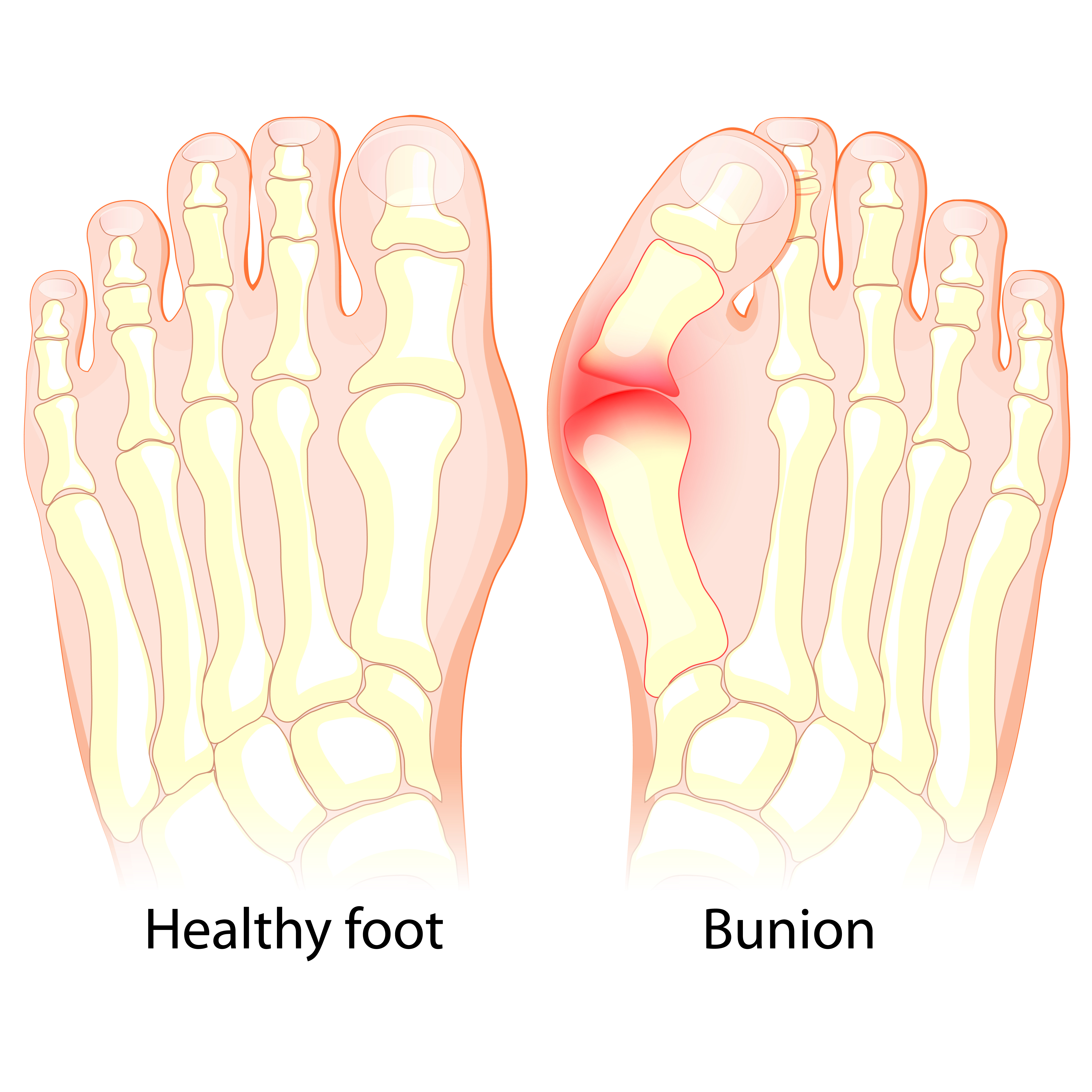 bones of bunion